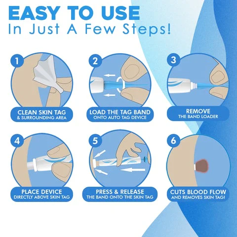 Schmerzloser Hauttag-Entferner – Sicher und Einfach für den Heimgebrauch