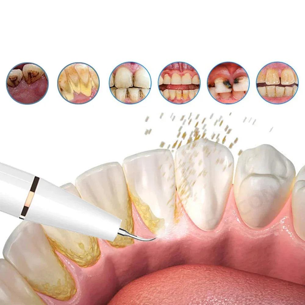 FreshSmile Ultraschall-Zahnbürste – Für Saubere und Gesunde Zähne