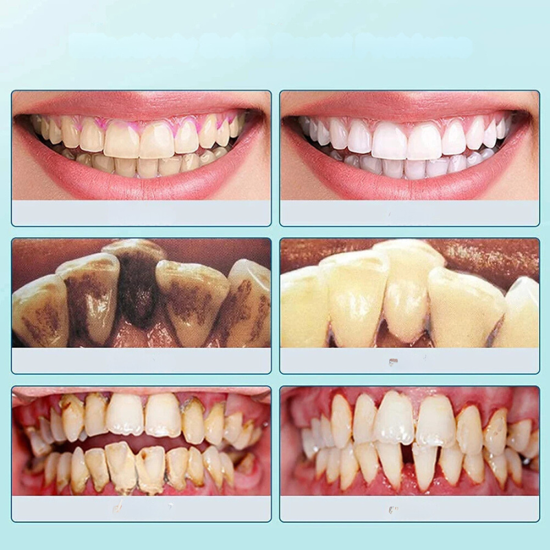 FreshSmile Ultraschall-Zahnbürste – Für Saubere und Gesunde Zähne